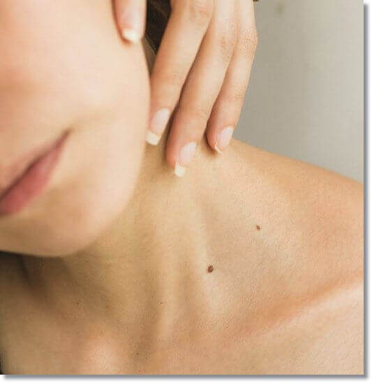 쥐젖 원인 및 제거 크림 효과, 가능한 부작용