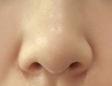 콧볼 보톡스 후기