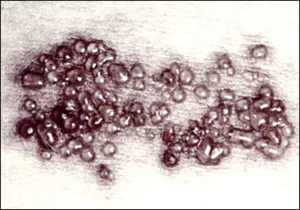대상포진 초기증상