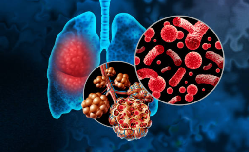폐렴 전염성&amp;#44; 증상&amp;#44; 치료기간 총정리 (2025ver)