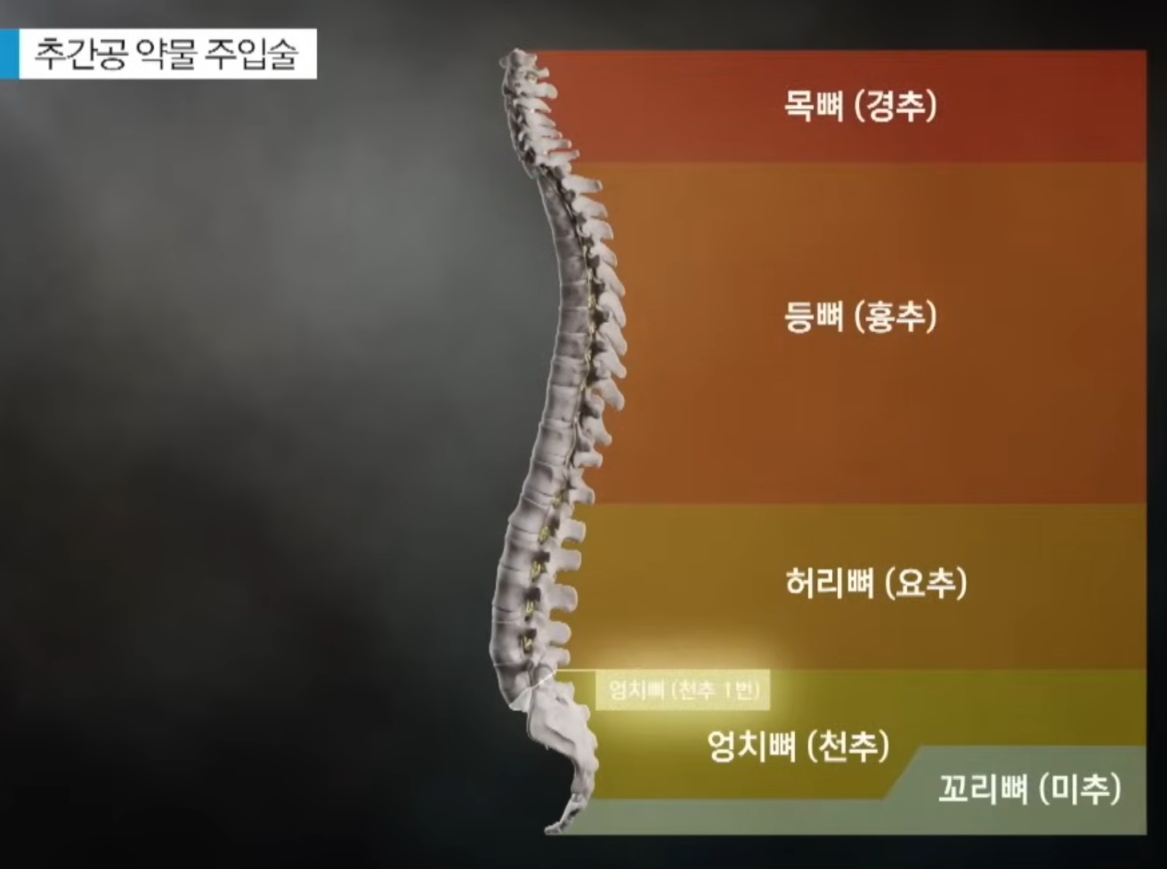 허리디스크-진동규-교수