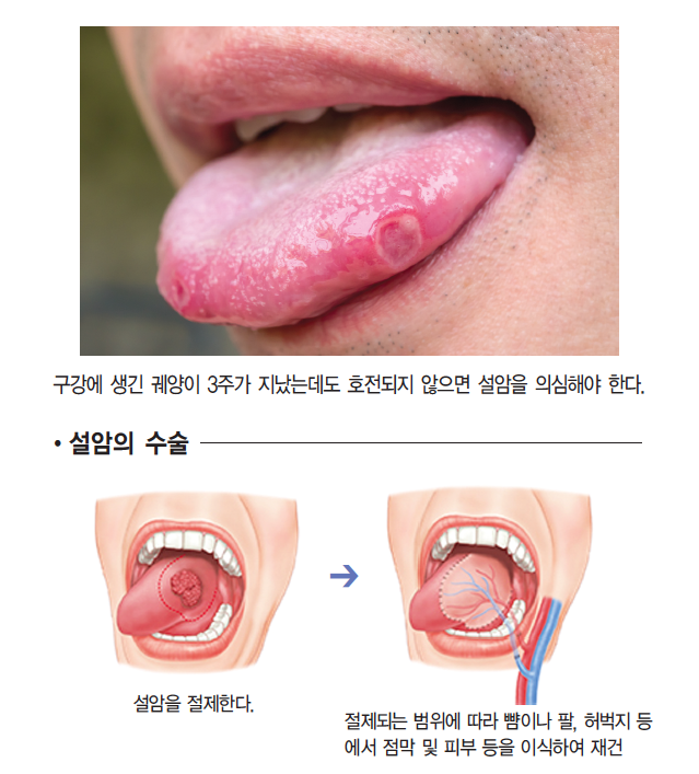 국립 암센터