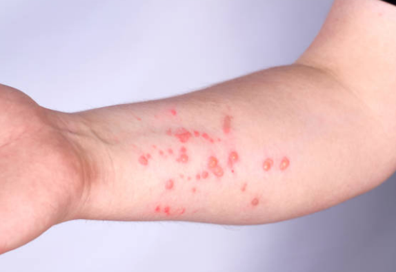 미녹시딜 부작용