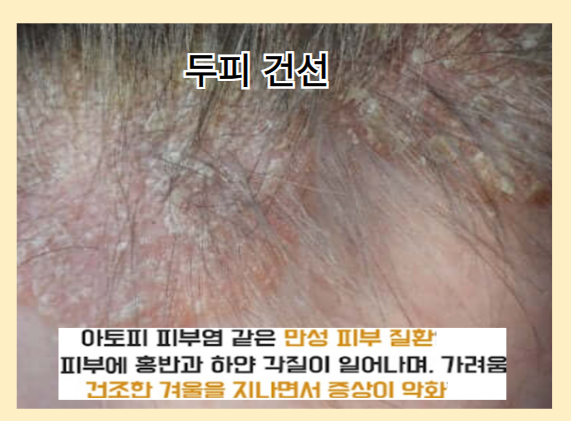 탈모를 악화시키는 나쁜 습관 - 두피 건선