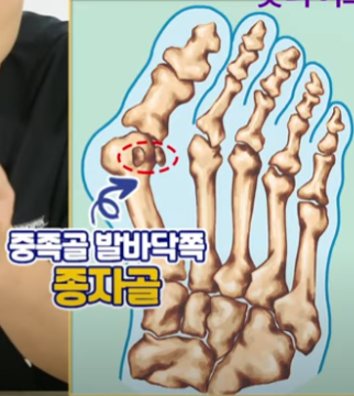 무지외반증 초간단 치료법&amp;#44; 무지외반증 교정기