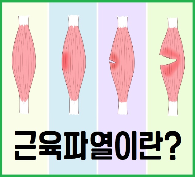 근육파열