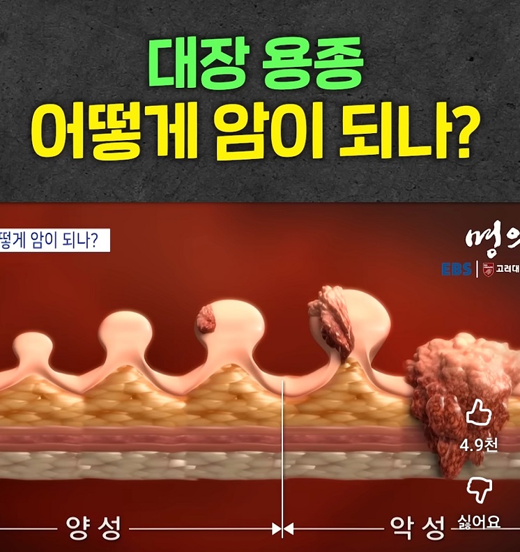 EBS-명의-대장암-용종-김형진-교수