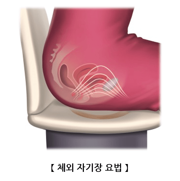 요실금 치료방법, 요실금 수술 비용, 요실금 팬티, 요실금 치료기 추천, 요실금 병원