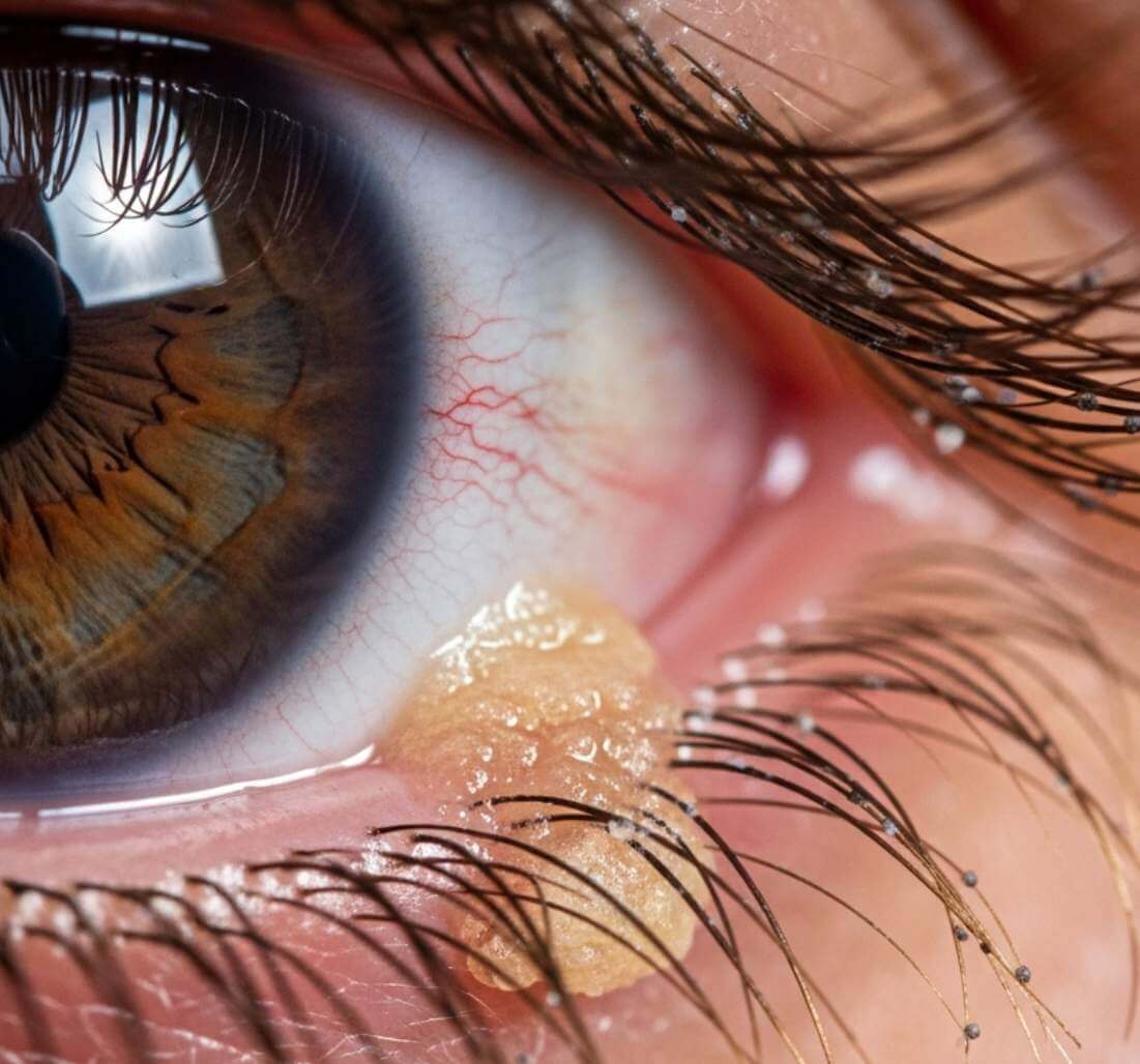 눈곱이 끼는 이유