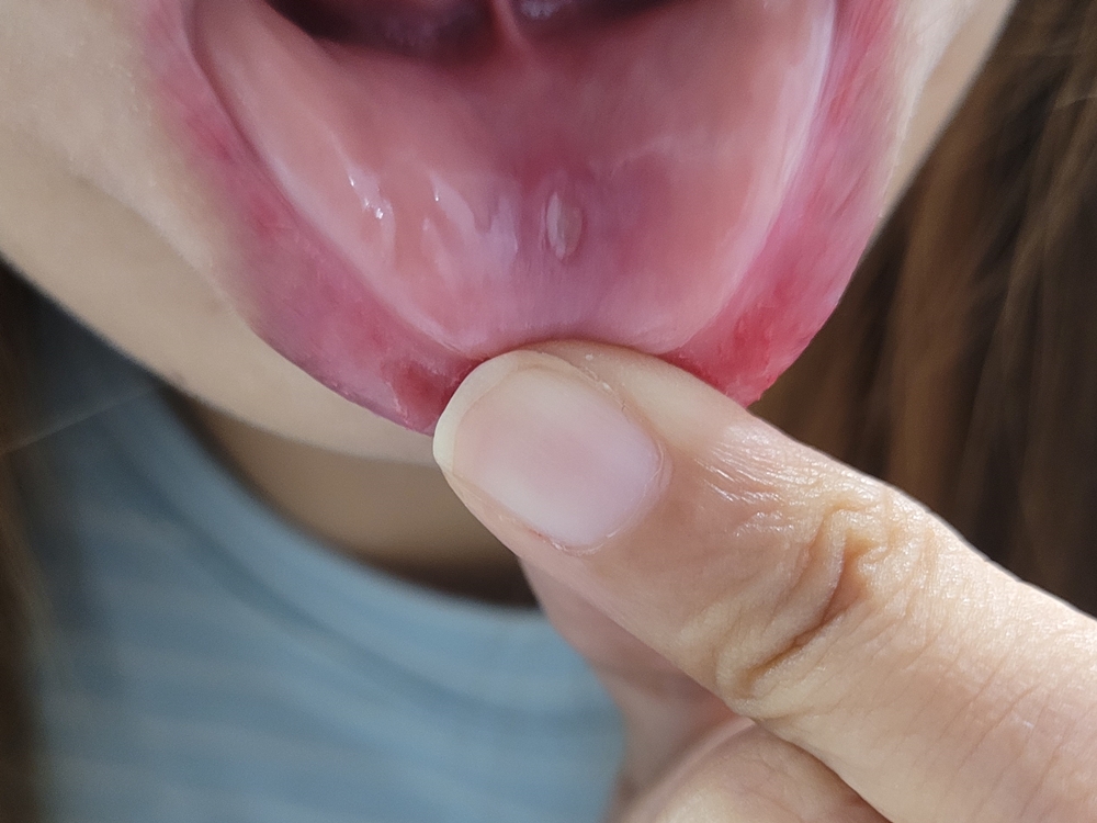 구내염 빨리낫는 법 원인과 증상