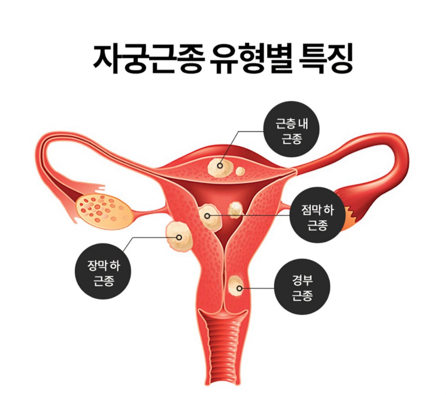 자궁근종 위치 사진