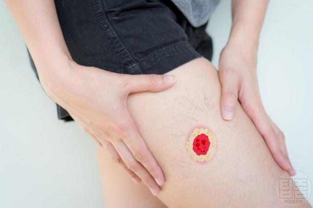 크론병 증상 피부 궤양