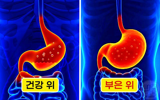 위가 부은 느낌 위가 붓는 이유