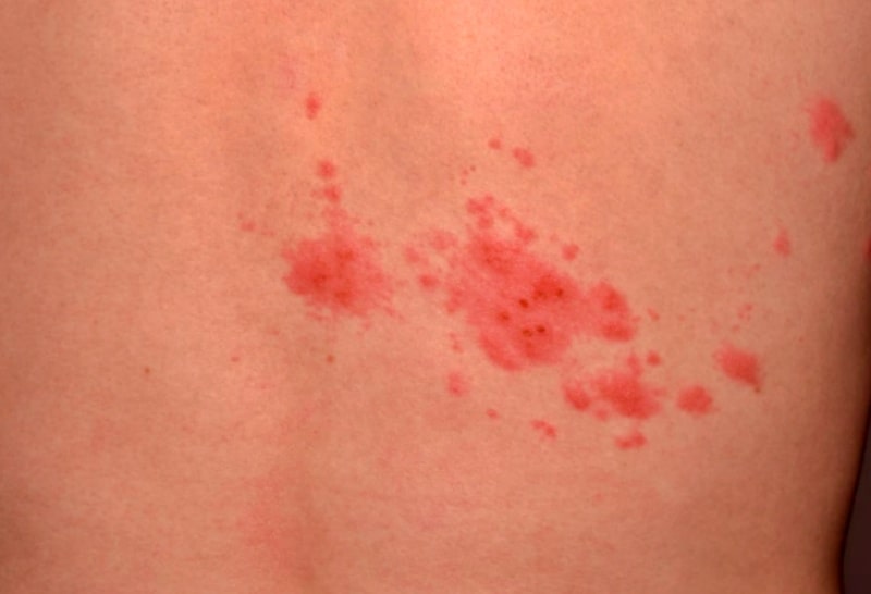 대상포진-초기증상