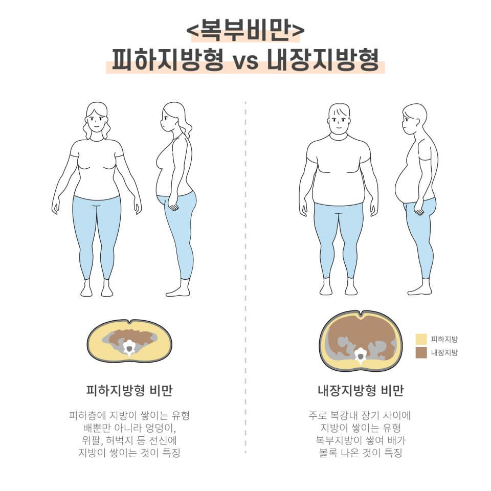 복부비만의 유형에 따른 배이미지