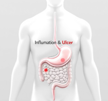 위염과 위궤양 차이점&amp;#44; 헷갈리는 분들 꼭 보세요