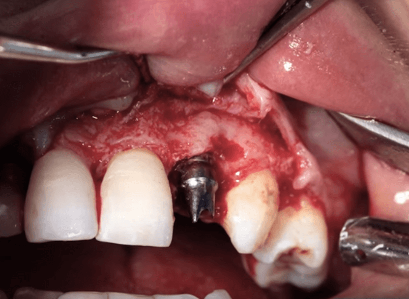 임플란트 주위염 ; 증상, 원인, 예방 및 관리방법 알아보기(재수술, 부작용, 재식립)