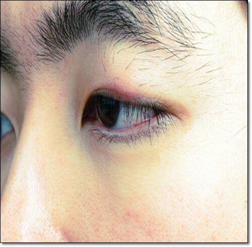 다래끼 난 남성