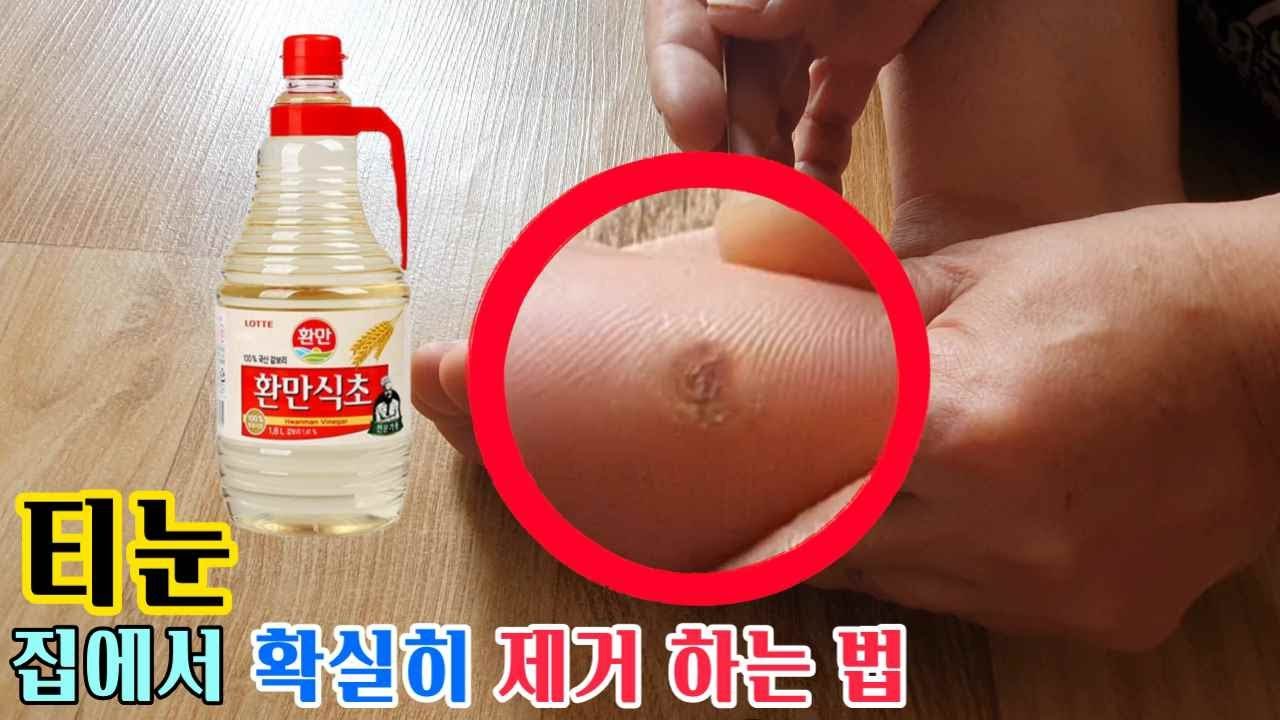 alt="티눈 집에서 확실히 제거 하는 법"