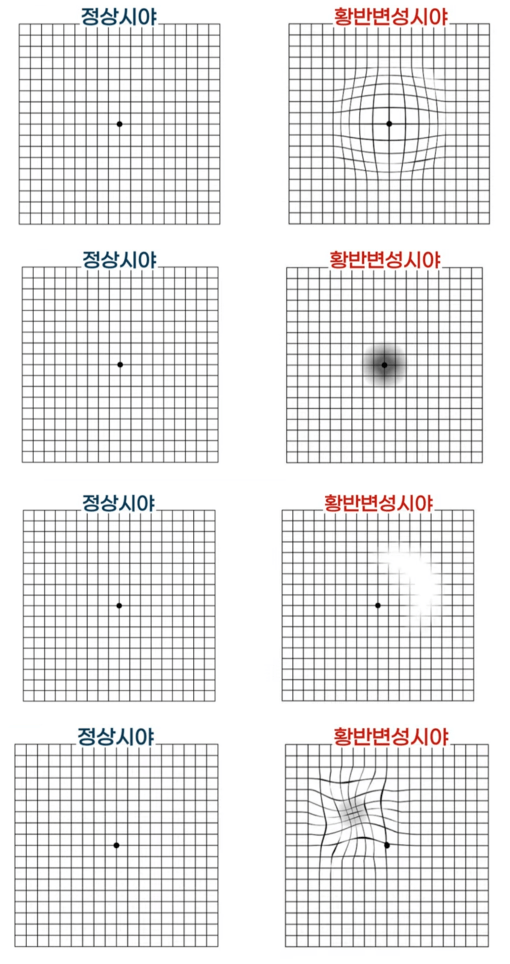 황반변성시야