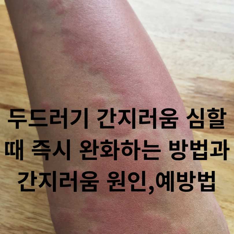 두드러기 간지러움 심할 때 해결방법과 원인