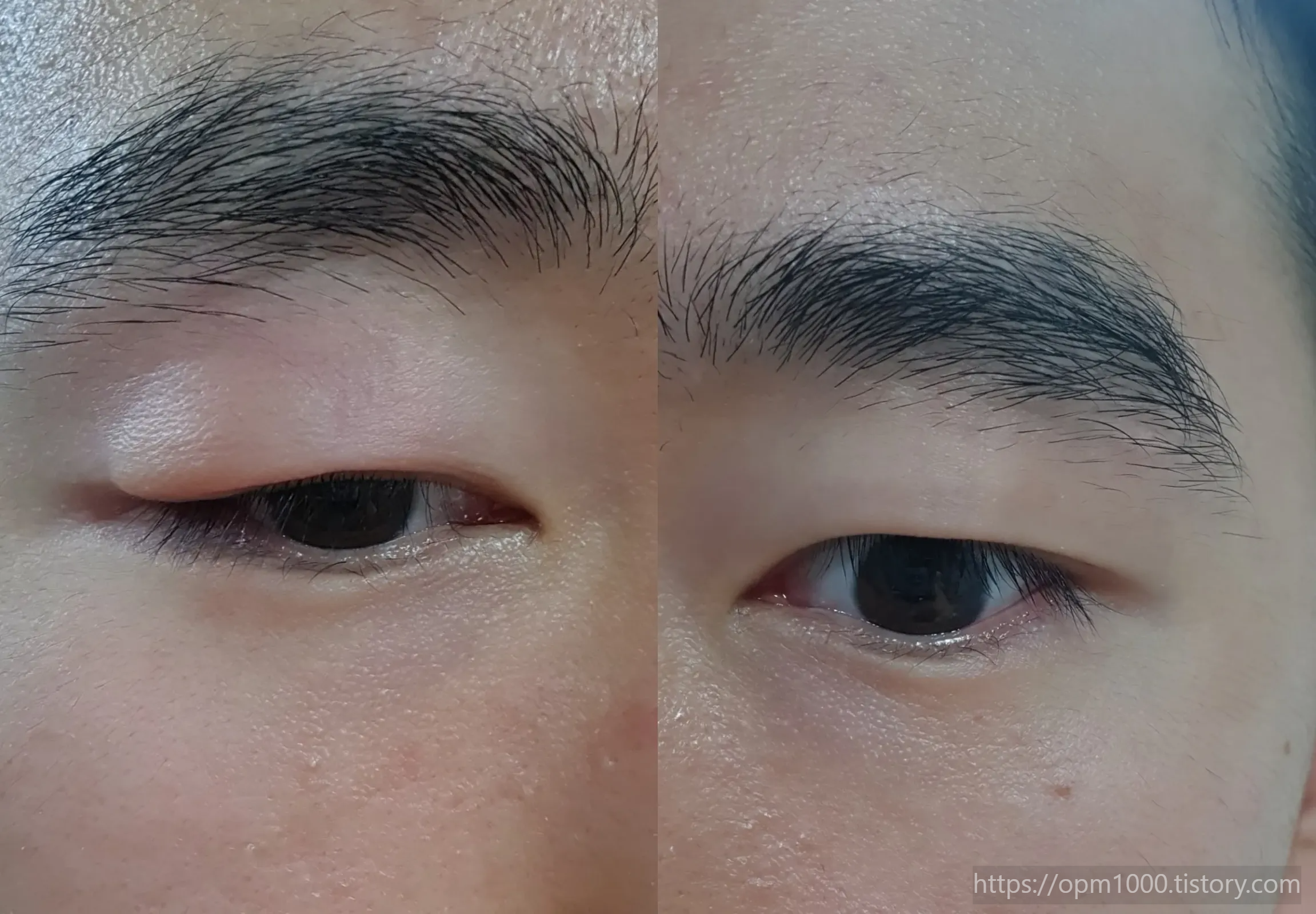 눈알러지-증상-한쪽눈-부어오름-좌우-비교-인증샷