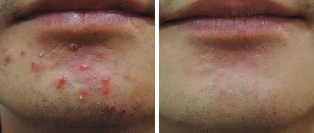 턱 주변 착색 원인과 턱밑 상처 관리 방법을 설명하는 스킨케어 가이드 이미지