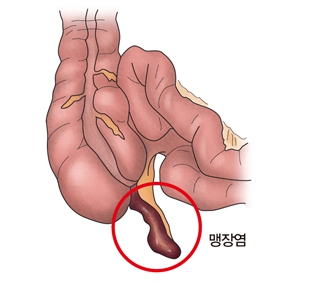 맹장염 (충수염)