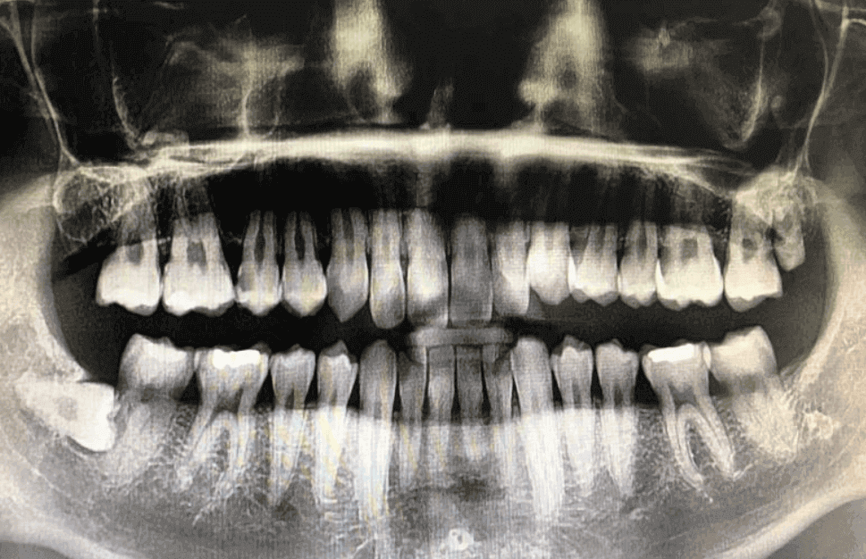 치과-파노라마-엑스레이-이미지