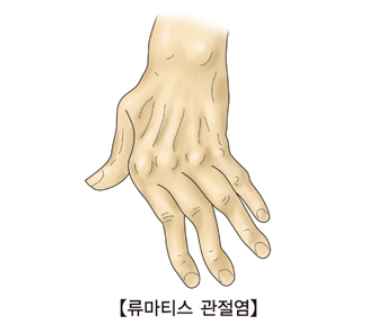 관절염의종류