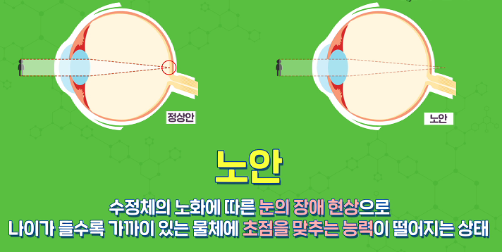 노안은 양안 시력의 불균형이다