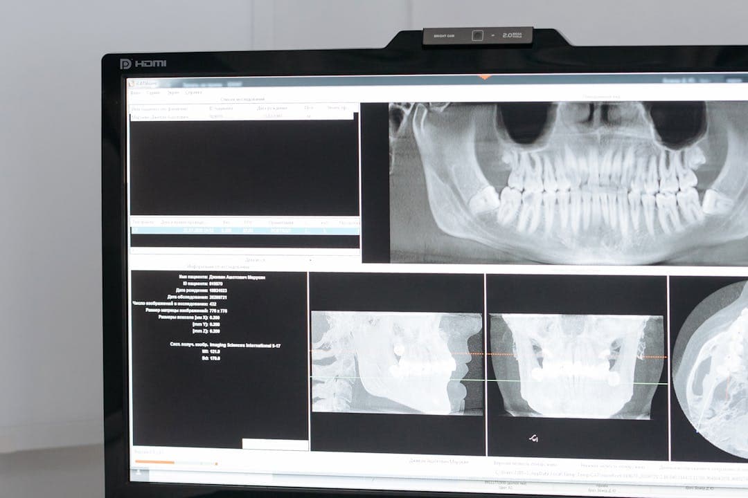 임플란트 치료 계획 수립을 위한 CT 스캔 화면