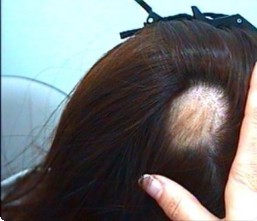 탈모지원금-설명사진