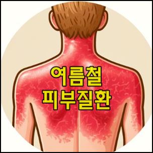 여름철 피부 질환