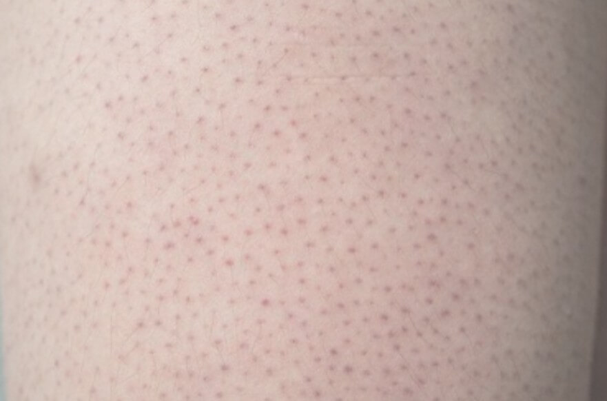 모공각화증 피부 증상