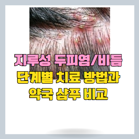 지루성피부염(두피염) 일반의약품 샴푸 선택 방법 및 가격 썸네일