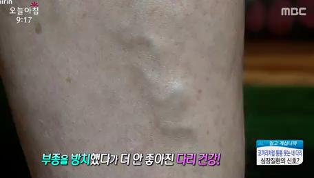 부종을 방치하여 심해진 상황