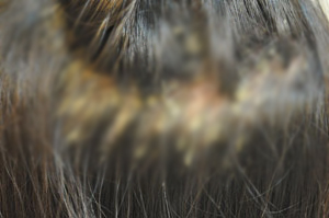 지성 두피 건성 두피 민감성 두피 탈모증상