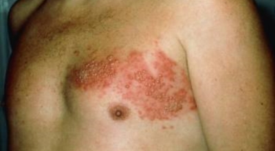 대상포진이미지