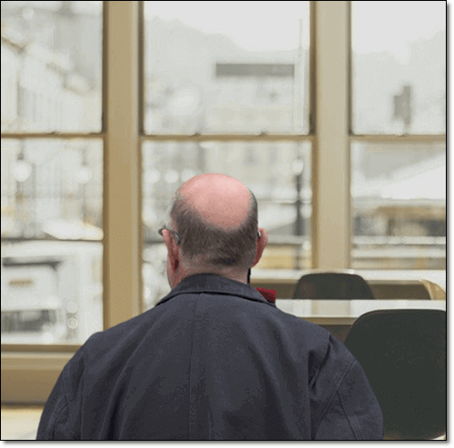 탈모 증상이 심한 노인