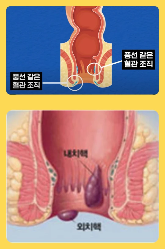 치질이란 치핵이라고 불립니다. 치핵에 대한 설명을 담은 사진