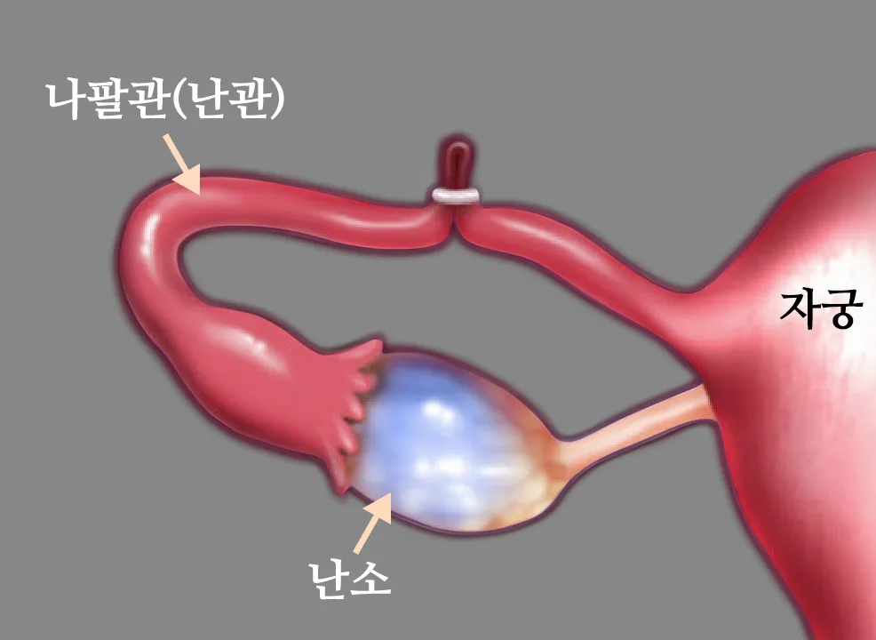 난관결찰술-링삽입-위치