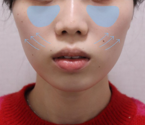 팔자 보톡스 후기