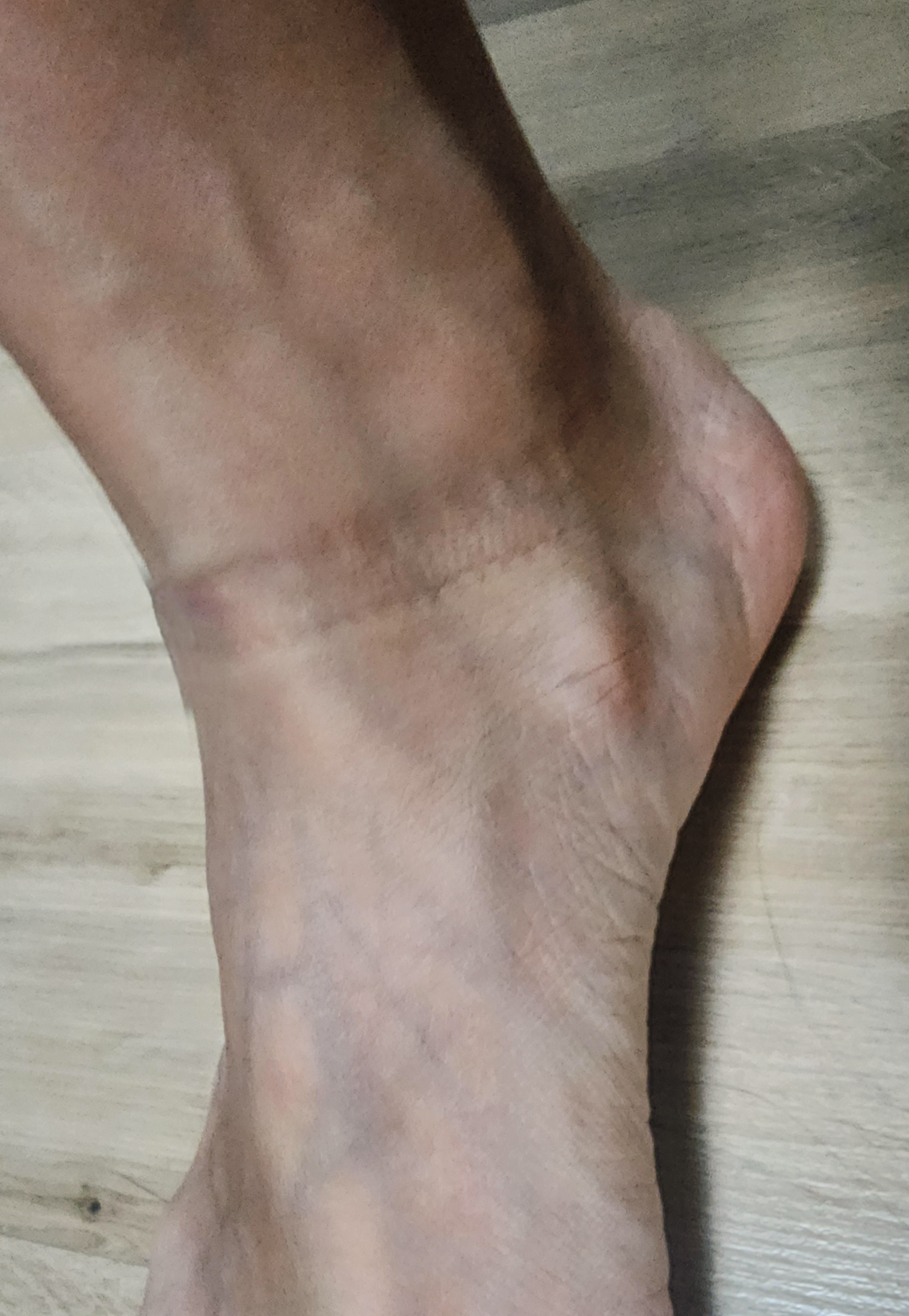 발안쪽 복숭아뼈 통증