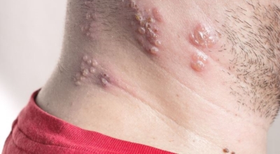 대상포진이미지