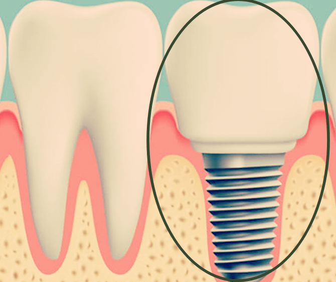 임플란트가-올바르게-식립된-모습