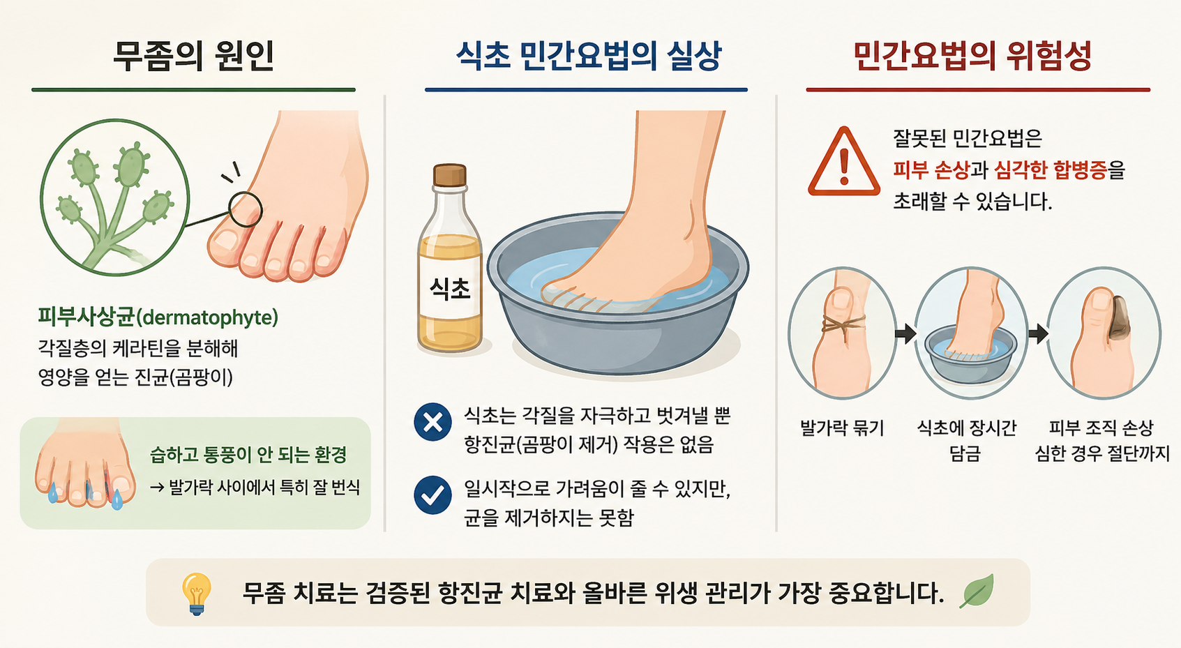 무좀 (민간요법, 생활습관, 치료제 선택)