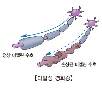 다발성경화증 원인부터 증상·치료