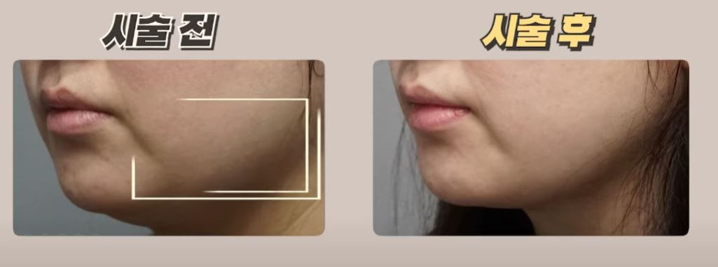 인모드 시술 결과