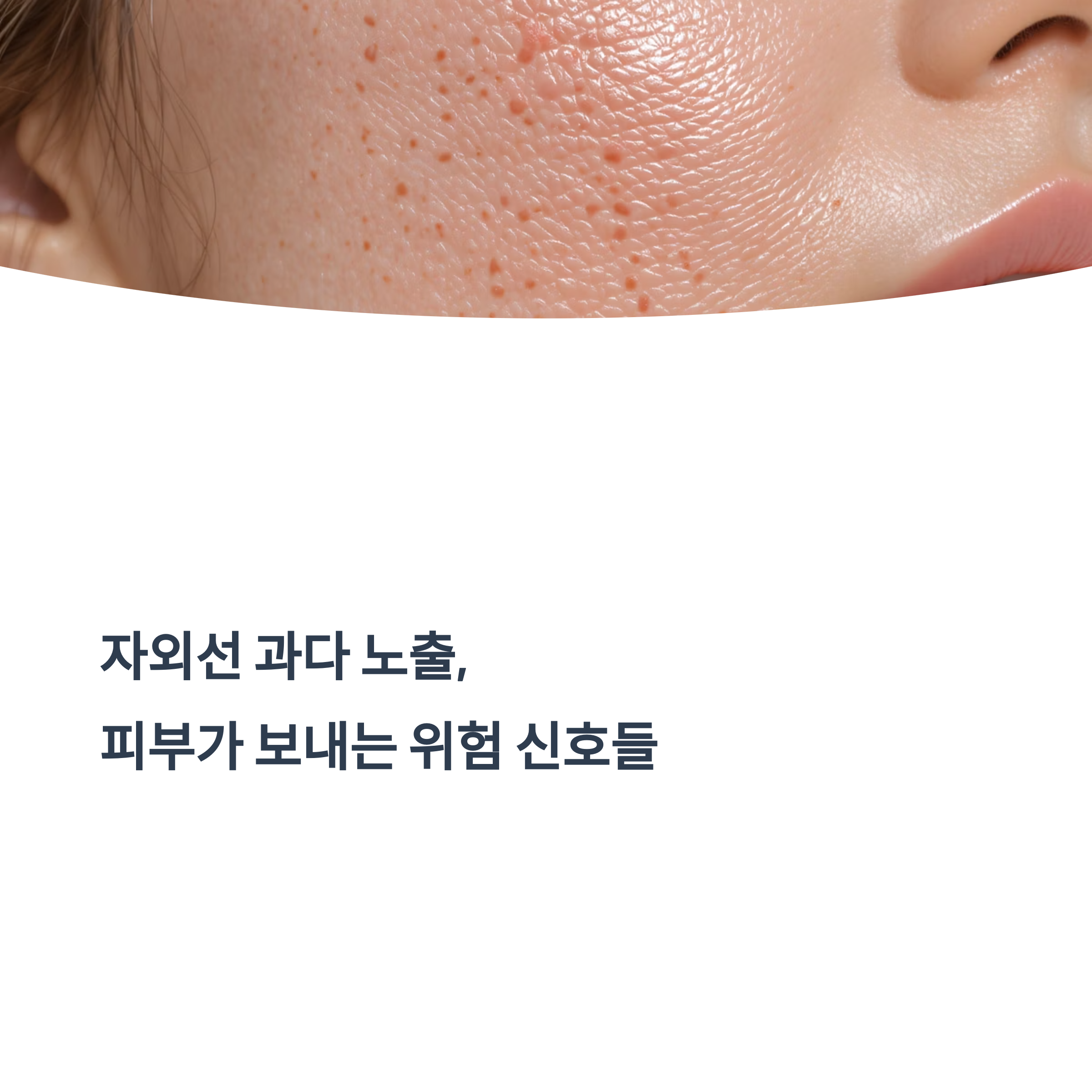 자외선 과다 노출, 피부가 보내는 위험 신호들